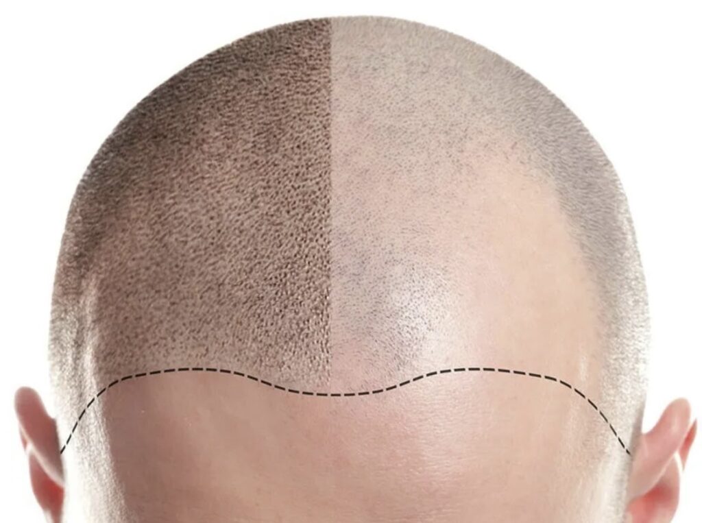 Vergleich Haarausfall und Kopfhautpigmentierung
