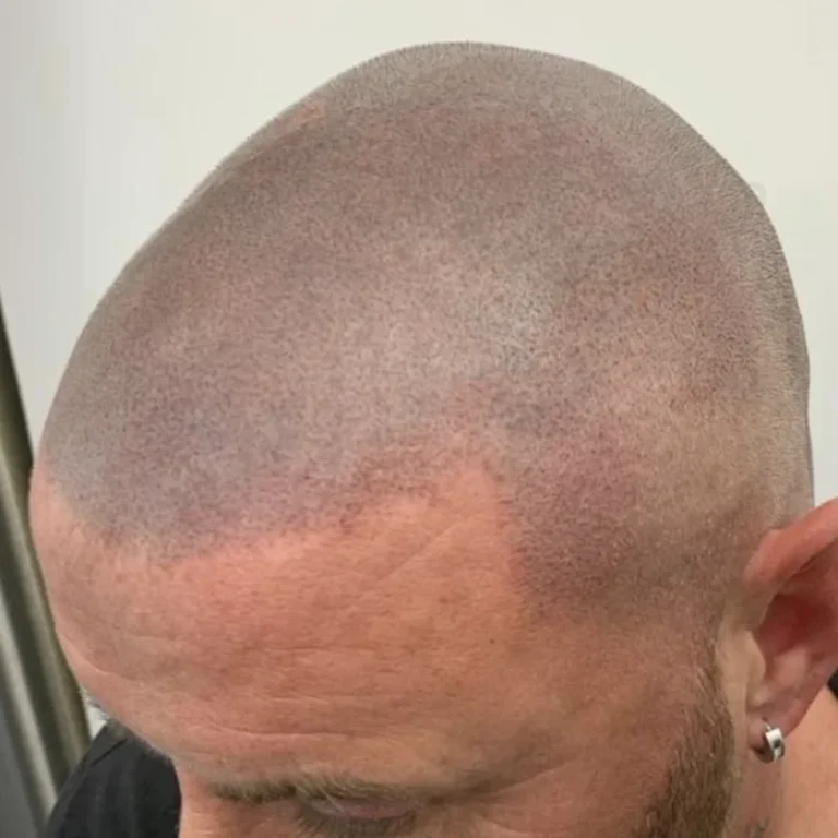 Micropigmentation Sculp